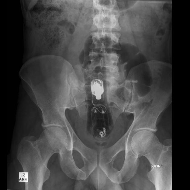 Удивительные рентгенограммы: инородные предметы в человеческом теле предмет, рентгенограмма, тело