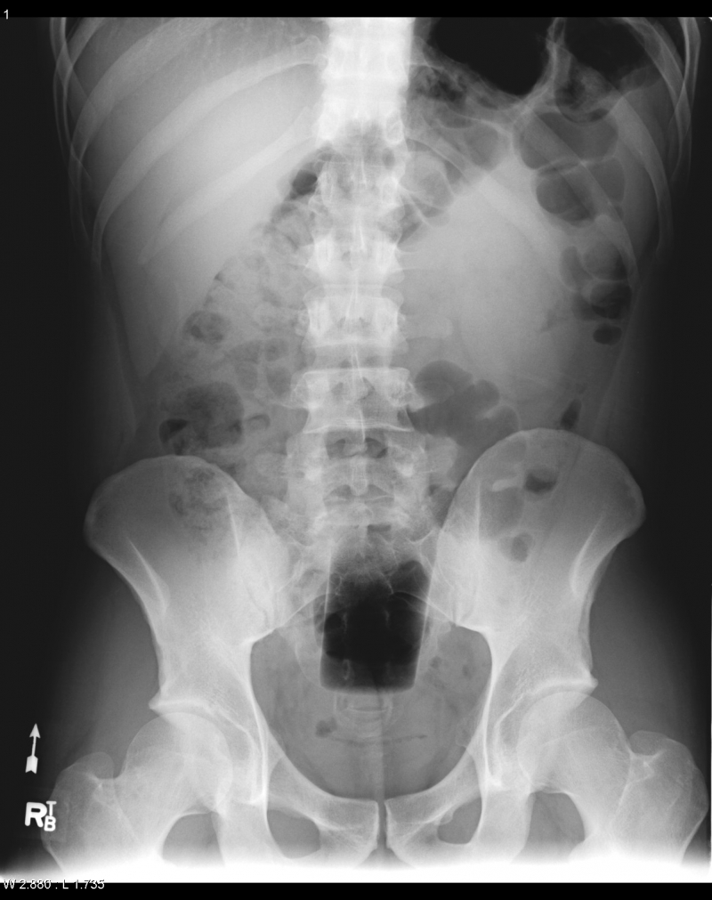 Удивительные рентгенограммы: инородные предметы в человеческом теле предмет, рентгенограмма, тело