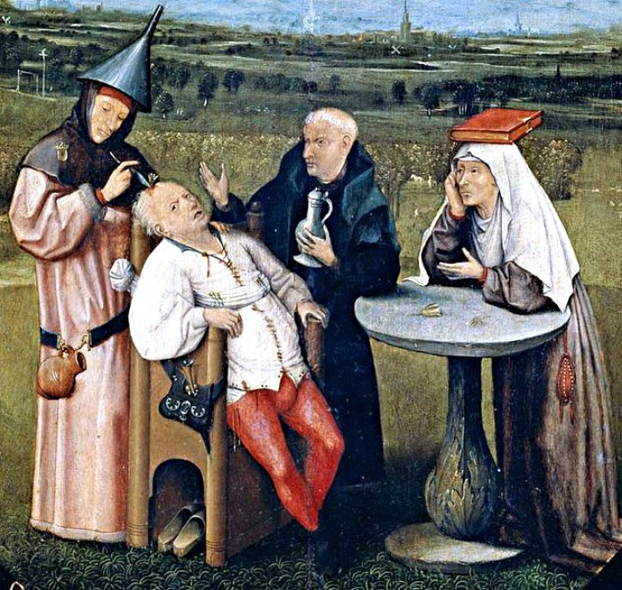 3. Трепанация. медицина, средние века