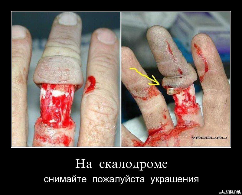 Содрал кожу с пальца до мяса Содрал кожу с пальца до мяса