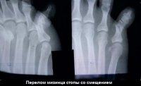 Та самая адская боль, когда ударил мизинец на ноге
