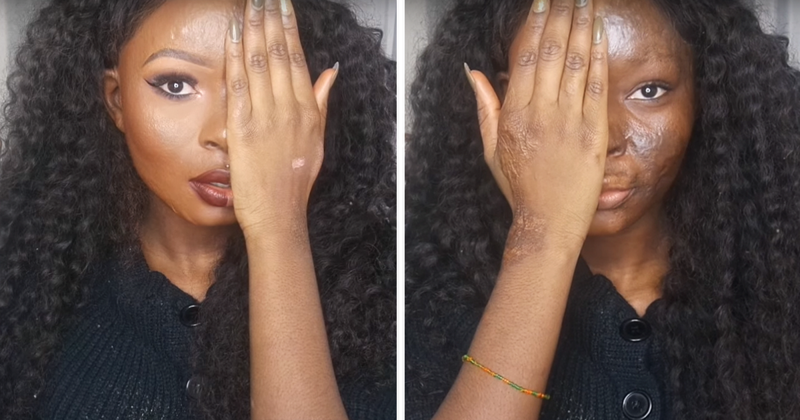 Burn Survivor Bullied At School Becomes Makeup Artist To Help Other Victims