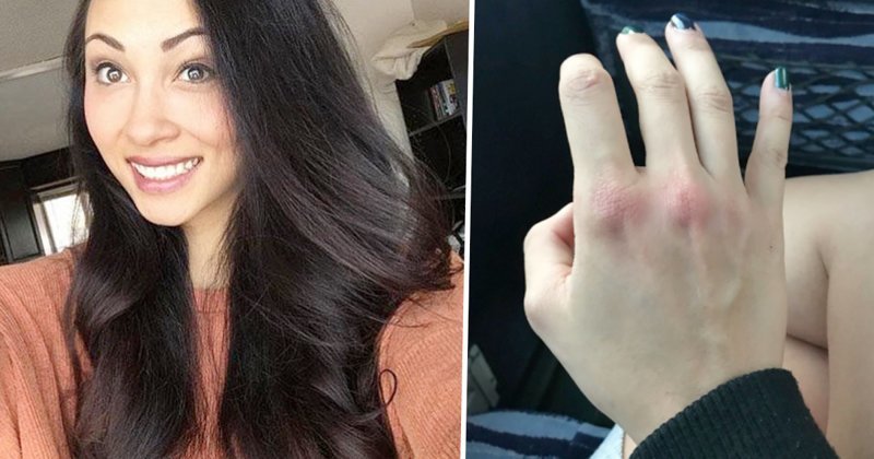 American tourist shares pictures of bruised hand after punching groper in Dublin