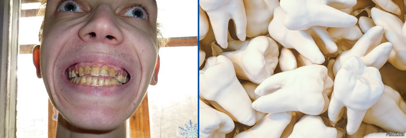 Почистил зубы струей под давлением: до и после